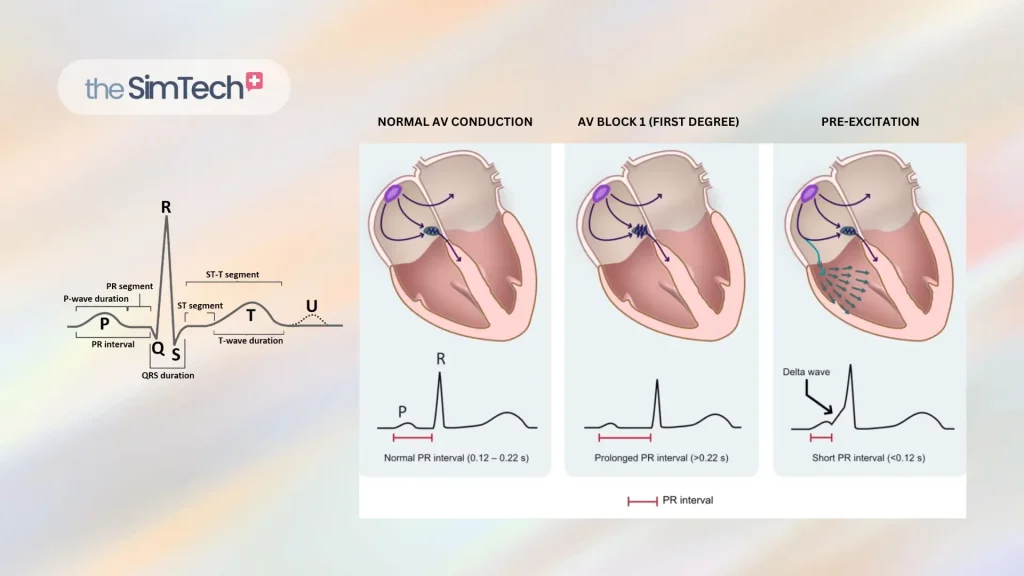 Diagram illustrating heart conduction with three panels: normal AV conduction, AV block (first degree), and pre-excitation. Includes ECG tracings below each heart, highlighting differences in PR intervals and presence of a delta wave.